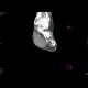 Plantar lymphoma: CT - Computed tomography